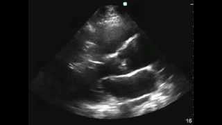 Bicuspid Aortic Valve [upl. by Bolte]