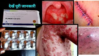 गोली 1 काम अनेक  Almox Cv 625 tablet uses in hindi  Amoxicillin amp potassium clavulanate in hindi [upl. by Atinev161]