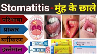 Stomatitis  मुंह के छाले का इलाज  Mouth Ulcer Treatment  Stomatitis In Hindi Muh Ke Chale Ka Ilaj [upl. by Casper600]