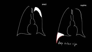 The deep sulcus sign of supine pneumothorax [upl. by Benenson]