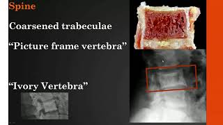 Imaging Paget disease of bone [upl. by Meesan]