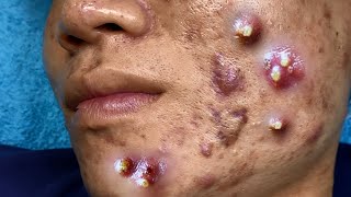 Big Cystic Acne Blackheads Extraction Blackheads amp Milia Whiteheads Removal Pimple Popping 095 [upl. by Yaya]