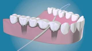 Bridge And Implant Floss by TePe [upl. by Berthoud]