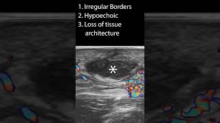 Characteristics of an Abscess pocus ultrasound [upl. by Tsenre198]