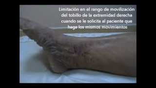 Insuficiencia Venosa Mixta mixed venous insufficiency [upl. by Noteloc]