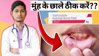 Triamcinolone oromucosal paste bp 01 ww  मुंह के छाले ठीक करें  Oraways paste in hindi [upl. by Michaud]