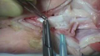 tendon repair [upl. by Cila]