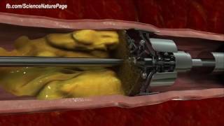 Diagnostic Cerebral Angiography [upl. by Macguiness]