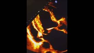 MV severe posterior leaflet prolapse with severe MR echocardiography cardiology science [upl. by Clite771]