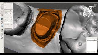 Creazione di un modello da impronta intraorale con pin articolatore meshmixer dental model [upl. by Cohla100]