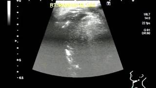 Ultrasound Video showing a small and illdefined mass in Parotid gland A rare case [upl. by Ardnaskela]