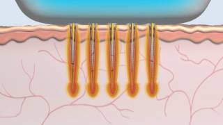 Animation Radiofréquence MicroNeedle Secret [upl. by Tam]