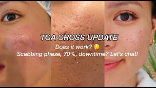 TCA CROSS UPDATE l ACNE SCARS [upl. by Noizneb415]