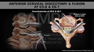 Anterior Cervical Discectomy amp Fusion at C56 amp C67 [upl. by Lurline]