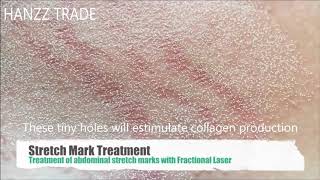 CO2 Fractional Laser Stretch Marks Treatment [upl. by Auehsoj48]