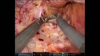 Robot segmental resction of rectum DE and anterior extrinsic adenomyomectomy [upl. by Orimisac]