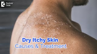 Dry itchy skin all over body Causes Diagnosis Treatment  Dr Rashmi Ravindra  Doctors Circle [upl. by Ambrogino]