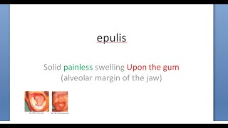 Surgery Epulis upon the gum jaw mouth swelling Gingivitis OsteoClastoma Giant Cell [upl. by Suravat]