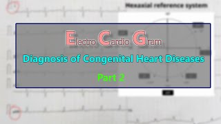 ECG Diagnosis of Congenital heart diseases PART 2 [upl. by Andromache108]