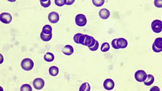 Rouleaux formation in blood smear [upl. by Mullen80]