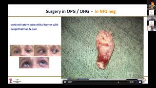 Optic Pathway Gliomas [upl. by Akoyin998]