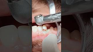 Tooth caries  composite restoration dentist [upl. by Ttehr]