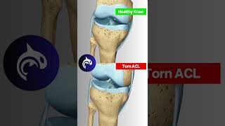 Why ACL Tears are such a nightmare for athletes acl [upl. by Kaslik255]