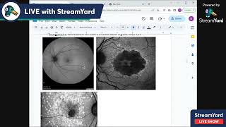 2 papilledema stages cf lab investigations pseudo papilledema [upl. by Inatsed]