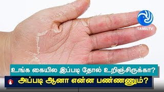 Home Remedy to Get Rid of Hand Skin Peeling  skin peeling off hands treatment  tamil [upl. by Leirbaj]