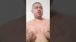 My Psoriasis Story [upl. by Aloisius]