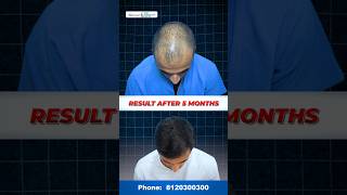 Hair Transplant  5 Months Result  My 5 Months Hair Transplant Result  Indore [upl. by Anirbed]