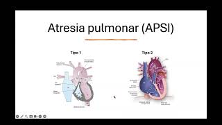 Atresia pulmonar [upl. by Yrocej289]