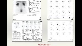 Renal Scintigraphy [upl. by Ahseyk124]