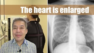 The heart is enlarged sa chest Xray [upl. by Irena911]