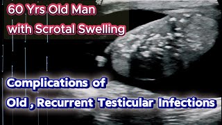 Complications of Old Testicular Infection  Epididymoorchitis  and Scrotal Swelling [upl. by Aniraad]