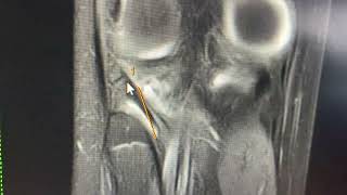 Fractura osteocondral vs ostecondritis disecante [upl. by Ardnasil]