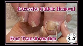 How to Remove Excessive Cuticle Buildup Callus Removal and Foot Massage 👍 [upl. by Bezanson]