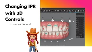 Invisalign ClinCheck  Changing IPR with 3D controls [upl. by Attiuqahs]