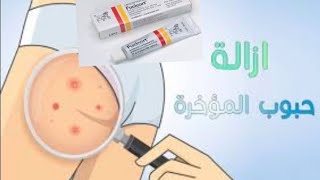 علاج سحري للتخلص من حبوب المؤخره وتحت الأبط من غير أي آثار للحبايه [upl. by Anreval]