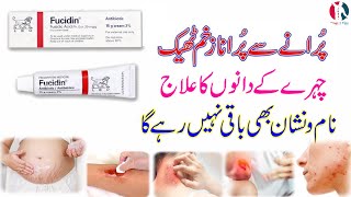 fucidin topical cream  fucidin cream  fucidin h cream uses in urdu  fucidin acid  how to use [upl. by Annodam123]