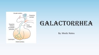 Causes amp pathophysiology of galactorrhea prolactinoma pituitary stalk compression hypothyroidism [upl. by Burra]