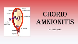 OampG Chorioamnionitis  risk factor signs and symptoms investigation treatment complication [upl. by Ace]