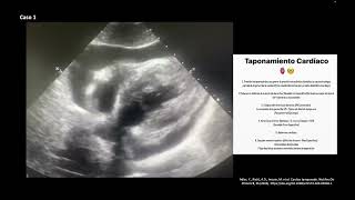 Casos de Taponamiento Cardíaco [upl. by Bore]