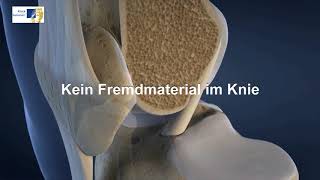 Knie OP bei Kreuzbandriss  3DAnimation Kniegelenk [upl. by Lemar181]