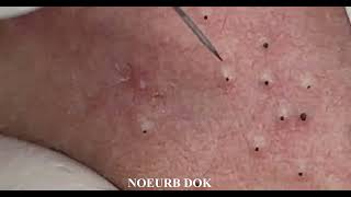 Popping Tons Of Blackheads Part 01 [upl. by Eppilihp561]