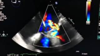 ASD Primum  TEE  Color Doppler  Echo Clip [upl. by Wiese]