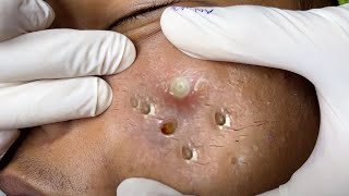 Big Cystic Acne Blackheads Extraction Blackheads amp Milia Whiteheads Removal Pimple Popping  634 [upl. by Hnid750]