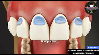 Composite filling in Abfraction tooth [upl. by Newlin]