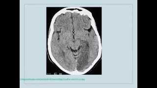 Clinical Pearls in Cerebrovascular Disease Neurology [upl. by Gallagher]