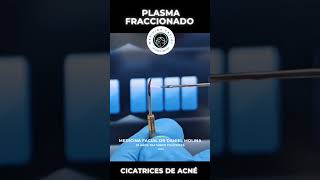 Plasmage para cicatrices de acné acnescars cicatrizdeacne cicatrizacion pielperfecta [upl. by Milurd]